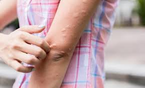 Hızla Yayılıyor: Asya Kaplan Sivrisineği Tehlikesi